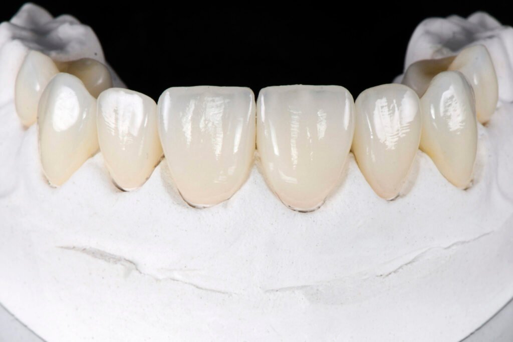 imagem facetas hub odonto
